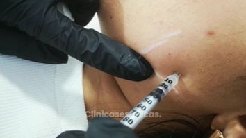 Bótox - Dra. Yulieth Figueroa Peñaranda