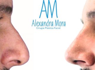 Rinoplastia - Doctora Alexandra Mora