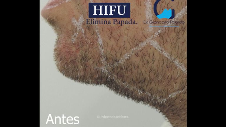 HIFU - Dr. Giancarlo Fajardo