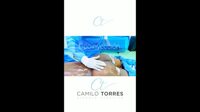 Lipoescultura - Dr. Camilo Rafael Torres Rodríguez