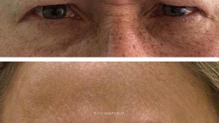 Toxina Botulínica - Doctora Alexandra Mora