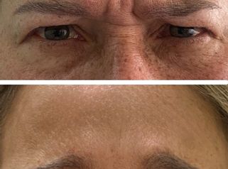 Toxina Botulínica - Doctora Alexandra Mora