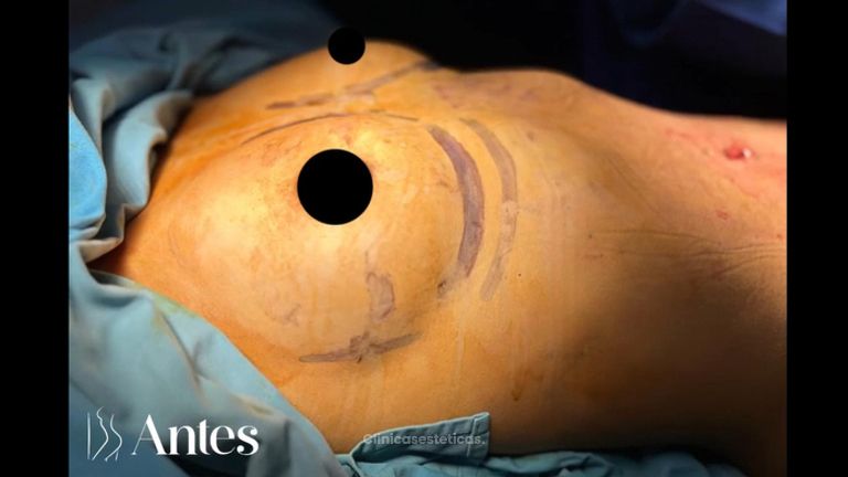 Mamoplastia de aumento - Dr. Reinel Mesa