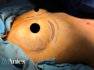Mamoplastia de aumento - Dr. Reinel Mesa