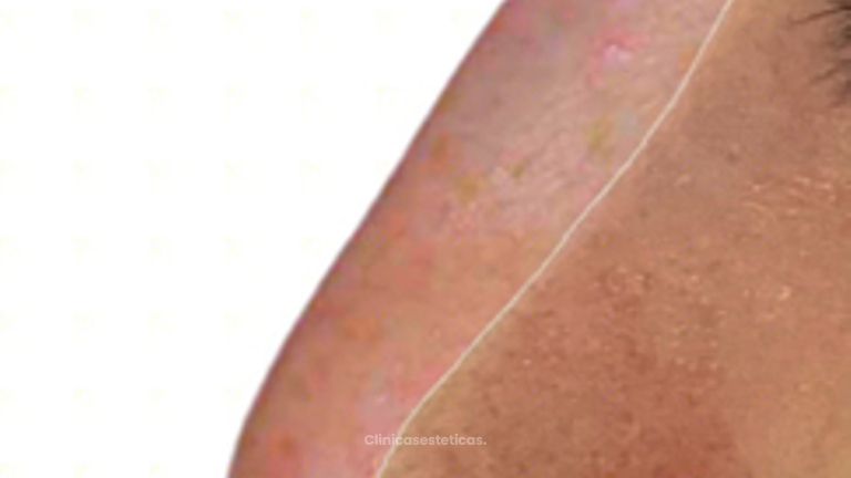 Rinoplastia - Doctora Alexandra Mora