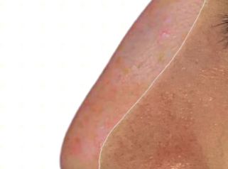 Rinoplastia - Doctora Alexandra Mora