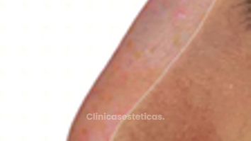 Rinoplastia - Doctora Alexandra Mora