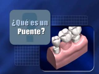 Prótesis dentales