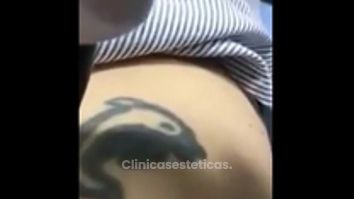 Borrar tatuajes con Laser