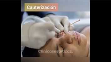 Proceso de  Cauterización