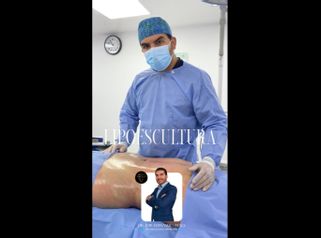 Lipoescultura - Dr. Luis Fernando Reyes & Dra. Nicole Echeverry