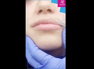 Aumento de labios - Doctora Alexandra Mora