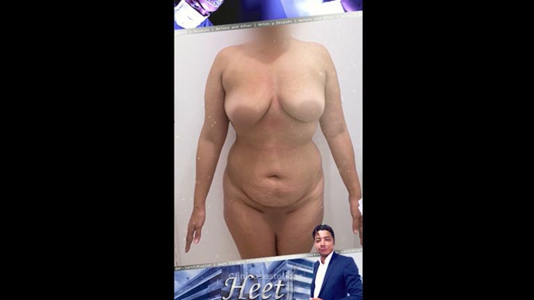 Liposucción - Dr. Jarold Effer Taylor