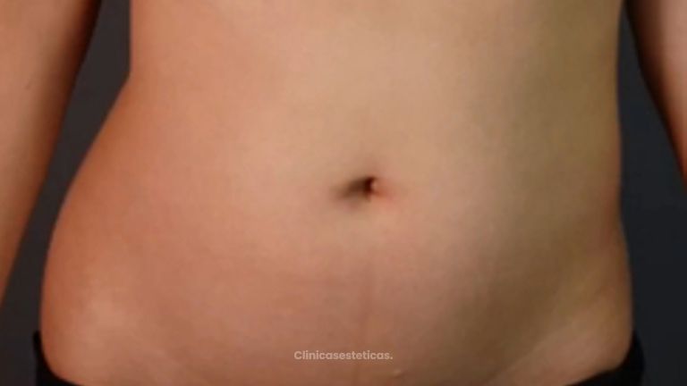 Liposucción - Dr Fulvio Alexander Correa