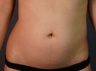 Liposucción - Dr Fulvio Alexander Correa