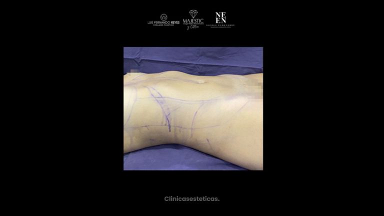 Liposucción - Dr. Luis Fernando Reyes & Dra. Nicole Echeverry