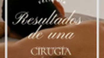 Marcacion Abdominal - Dr. Felipe Galiano