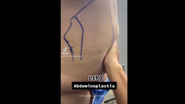 Abdominoplastia - Dr Fulvio Alexander Correa