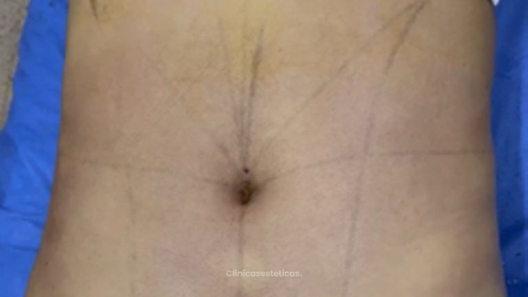 Lipólisis HD - Dr. Tobias Gutiérrez