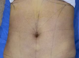 Lipólisis HD - Dr. Tobias Gutiérrez