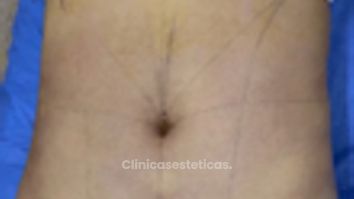 Lipólisis HD - Dr. Tobias Gutiérrez