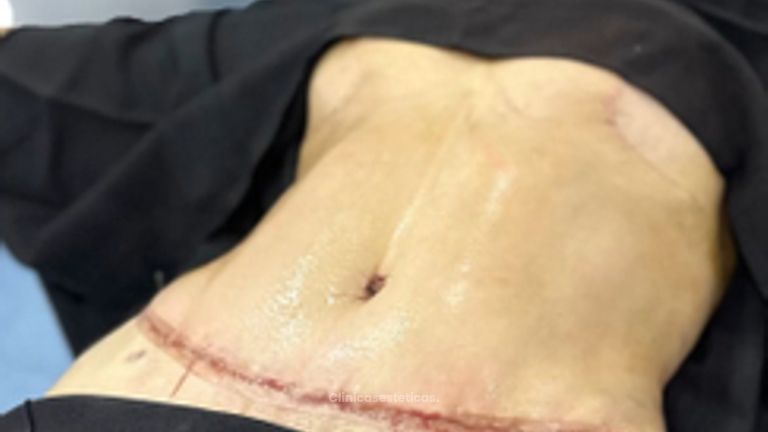 Abdominoplastia - Dr. Reinel Mesa