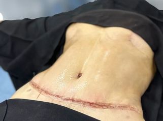 Abdominoplastia - Dr. Reinel Mesa