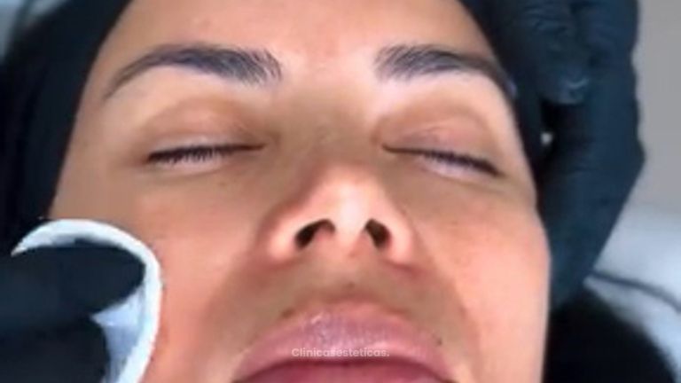 Peeling - Dra. Carmen Padilla