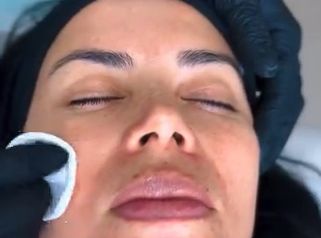 Peeling - Dra. Carmen Padilla