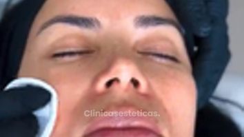 Peeling - Dra. Carmen Padilla