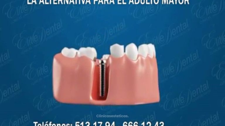 Así funcionan las prótesis fijas