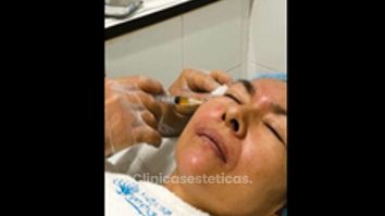 Rejuvenecimiento facial con plasma rico en plaquetas