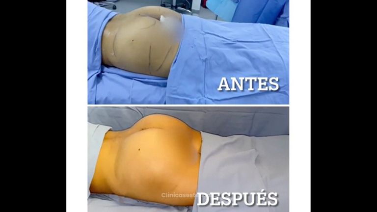 Gluteoplastia - Dr. Hugo Javier Mejía Cuello