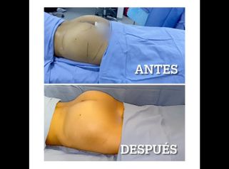 Gluteoplastia - Dr. Hugo Javier Mejía Cuello