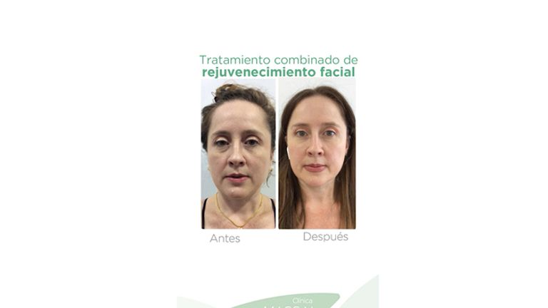 Rejuvenecimiento facial - Massai Clínica