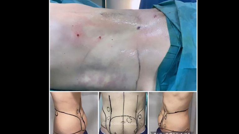 Liposucción - Dr. Felipe Galiano