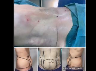 Liposucción - Dr. Felipe Galiano