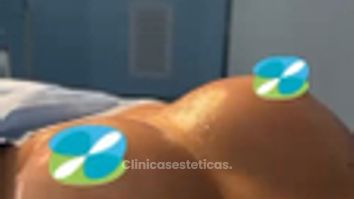 Mamoplastia de aumento - Clinica Vivir