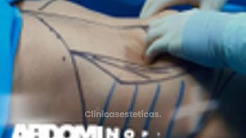 Lipo 360 - Dr. Jorge Puello White