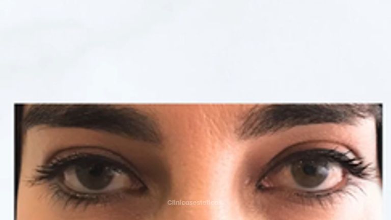 👁 Tratamiento de ojeras