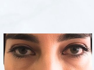 👁 Tratamiento de ojeras