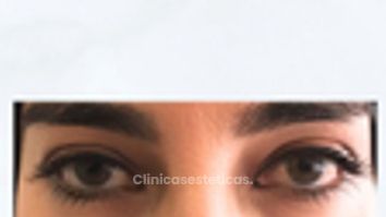 👁 Tratamiento de ojeras