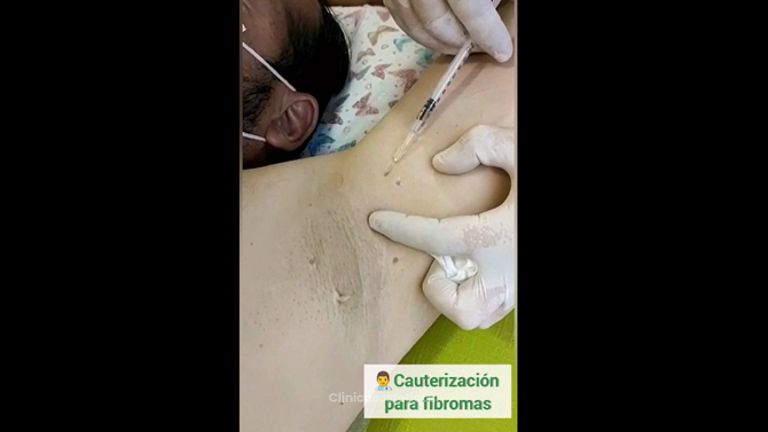 Cauterización - Kairos Salud Integral