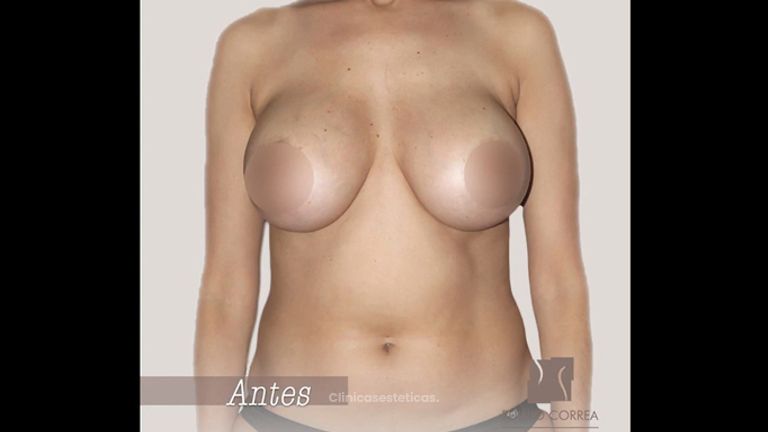 Mamoplastia de aumento 