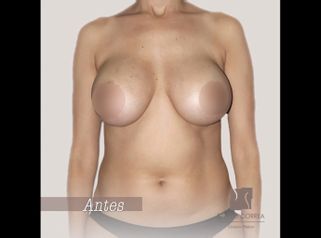 Mamoplastia de aumento 