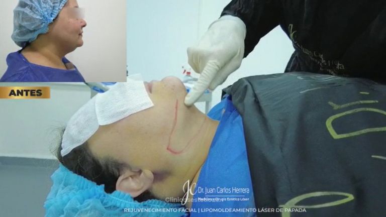 Liposucción de papada - Dr. Juan Carlos Herrera P.