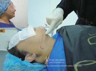 Liposucción de papada - Dr. Juan Carlos Herrera P.