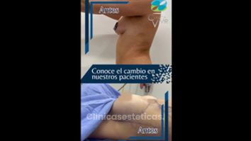 Mamoplastia de aumento - Clínica Vivir