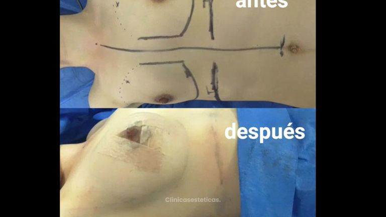Antes y después mamoplastia de aumento.  
