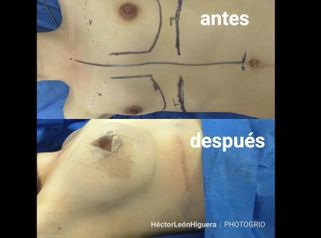 Antes y después mamoplastia de aumento.  